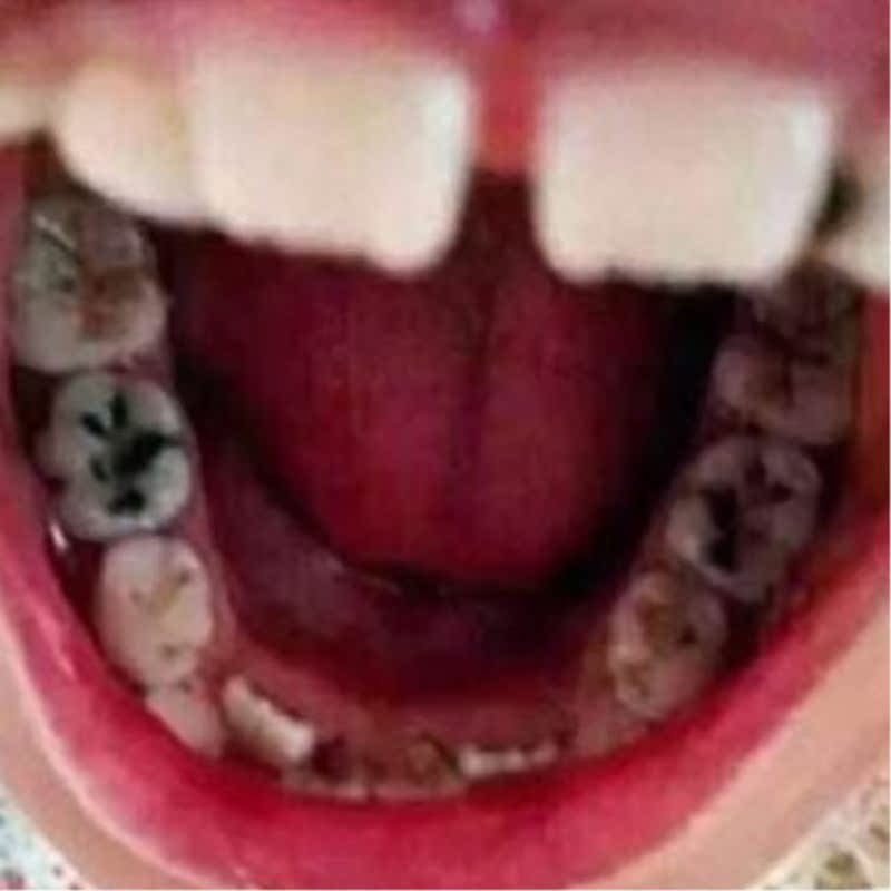 牙疼牙痛特效神经蛀虫消炎牙龈肿痛喷剂孕妇儿童蛀牙成人治牙痛水