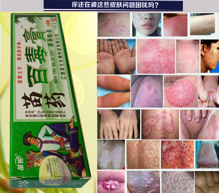 肛门阴囊潮湿外阴肛周痒男女大腿内侧痒成人股藓止痒膏皮肤软膏