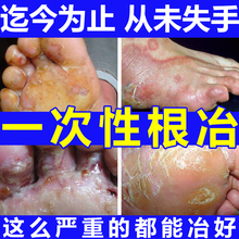 治脚气真菌感染脚臭脚痒脱皮水泡糜烂手足癣泡脚粉杀菌止痒喷剂膏