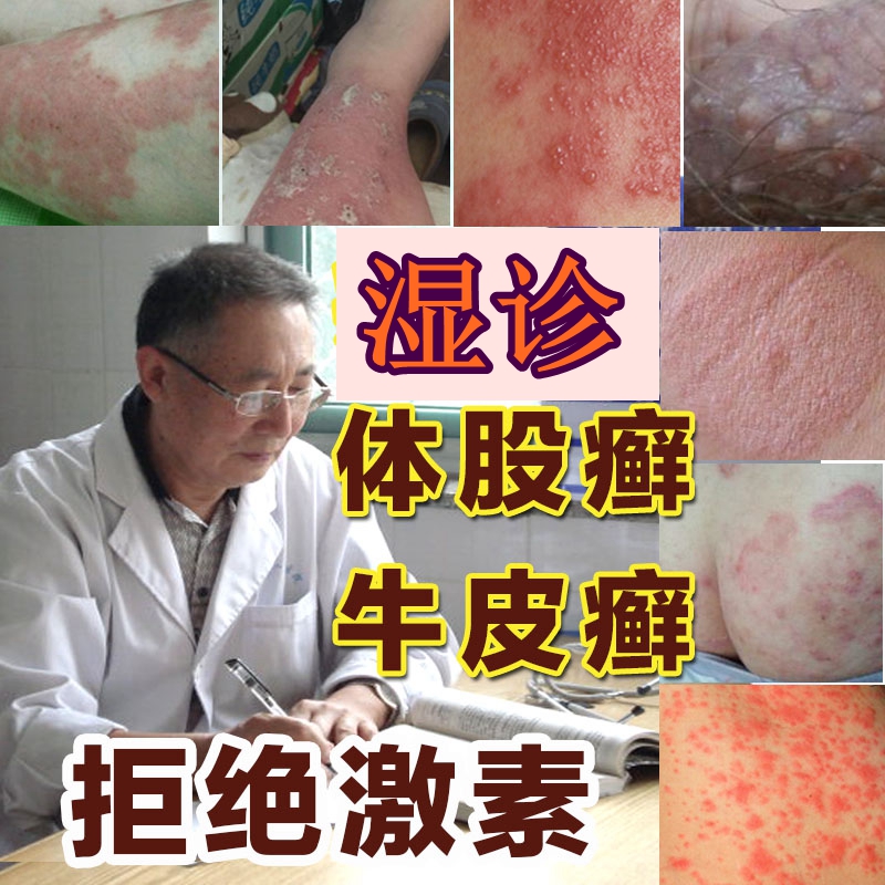 牛皮藓皮肤止痒药膏湿毒红疹偏方银屑癣大腿内侧阴囊止痒外用乳膏