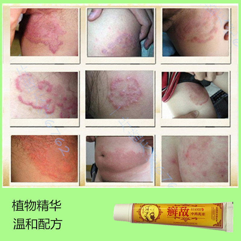男女大腿内侧体股手足皮肤痒藓廯外用软膏肛门阴囊外阴止痒膏成人