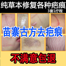 祛疤膏去疤痕凹凸疤修复膏手术伤疤烫伤膏除疤膏凝胶痘印灵贴