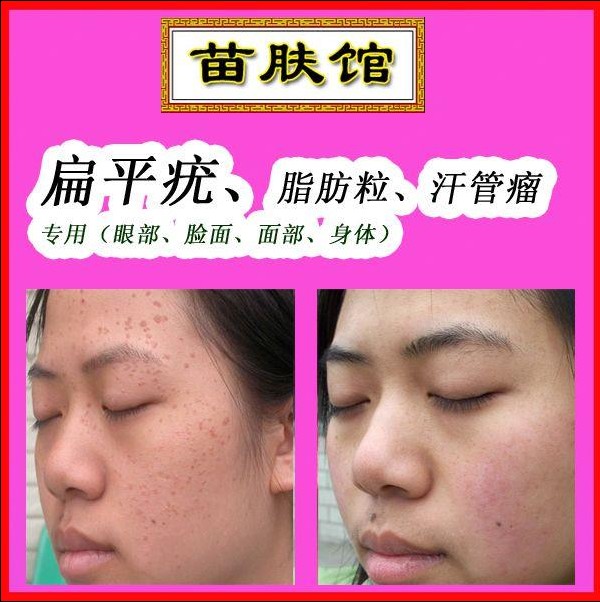 特效去除面部扁平疣眼部丝状疣手部脖子去疣软疣寻常疣必治精华液