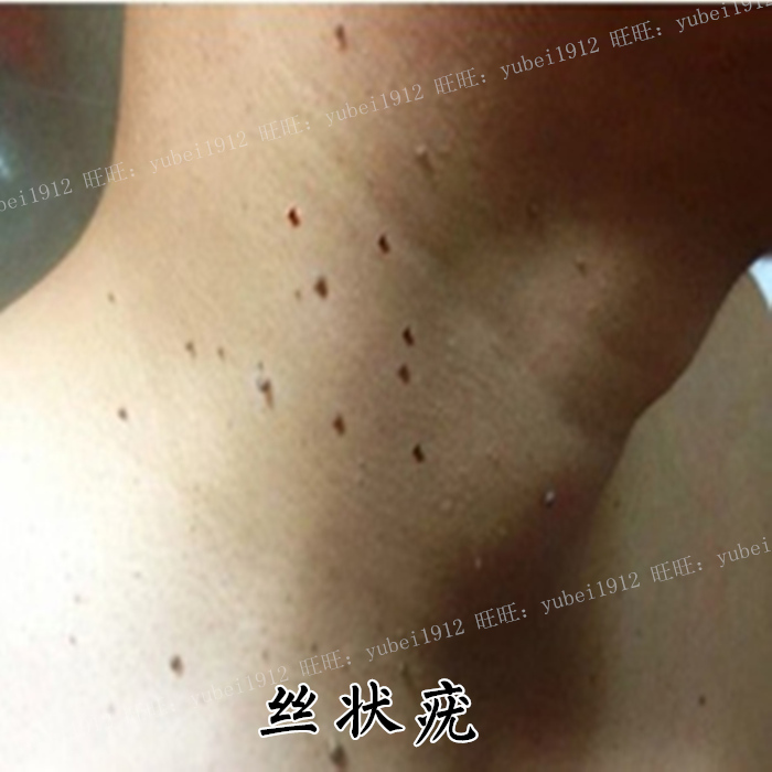 不好就退】去丝状尤脖子腋下肉粒 皮赘 跖尤 趾尤 猴子_双氙车灯改装