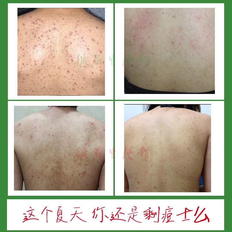 背部祛痘淡化痘印痘疤粉刺去胸前后背痘痘清爽无痕祛痘喷雾产品