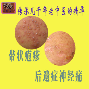 缠腰龙 蛇盘疮 带状后遗症神经*痛 蛇胆疮 带状疱*疹 蜘蛛疮