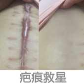 疤痕灵去除黑色素沉淀修复膏手术刀疤凹凸疤痕疙瘩伤疤祛痘印正品