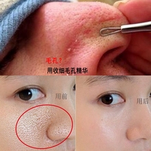 大毛孔克星 收缩毛孔精华液收毛孔粗大修复面部精华紧致男女士