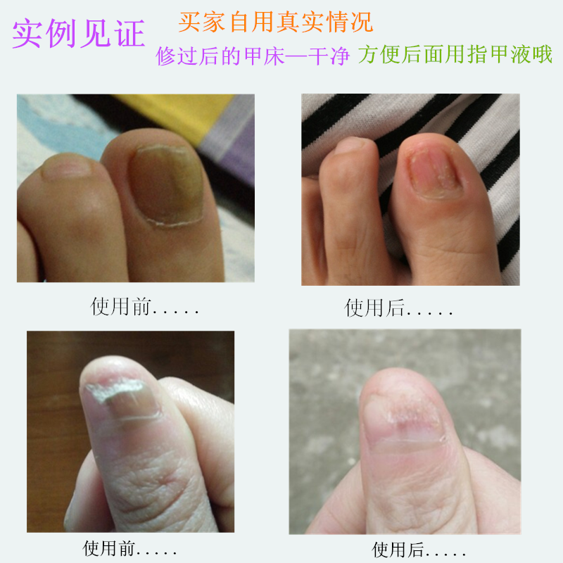 软甲膏去灰甲指甲软化液去除灰脚趾指甲亮甲正品脚指甲增厚专用水