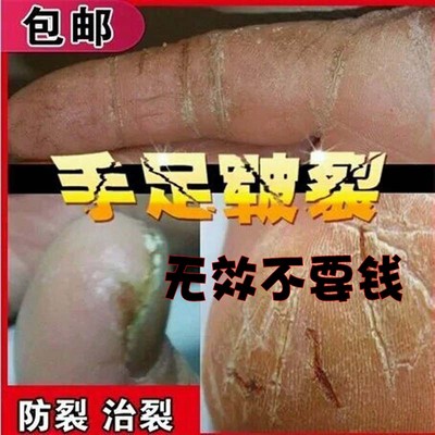 脚裂膏特效治手裂脚后跟干裂口子药灵霜裂净手
