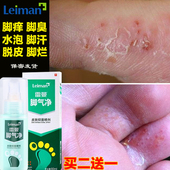 治脚气脚臭脚痒脱皮真菌感染糜烂脚丫型水泡止痒杀菌药膏特效喷剂