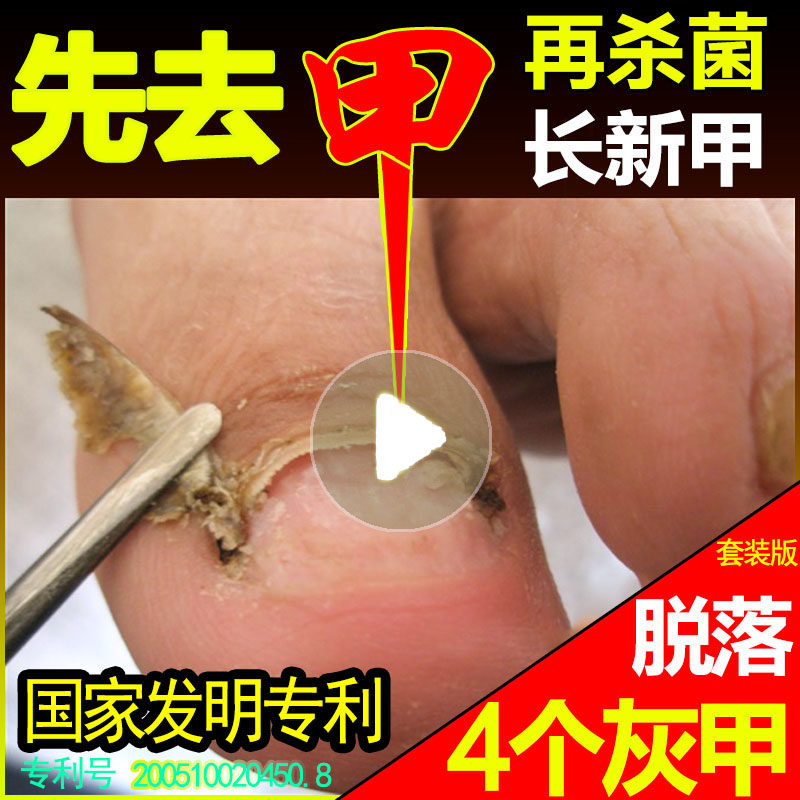 灰甲净亮甲正品灰指甲特效灰趾甲灰甲清软甲膏灰甲去除增厚专用液