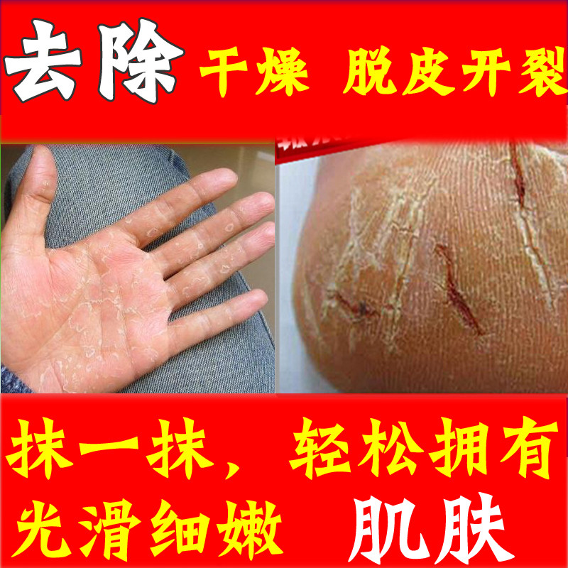 手皲裂图片,冬天手背皲裂图片,手背皲裂图片_大山谷图库